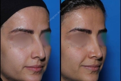 nose-surgery-0134