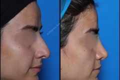 nose-surgery-0135
