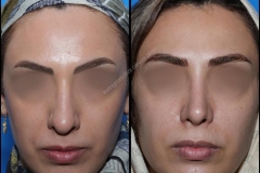 nose-surgery-0136