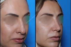 nose-surgery-0137