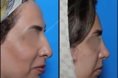 nose-surgery-0138