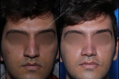 nose-surgery-0139