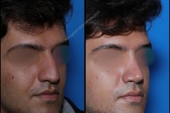 nose-surgery-0140