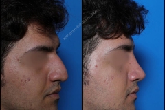nose-surgery-0141