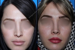 nose-surgery-0142