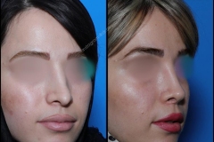 nose-surgery-0143