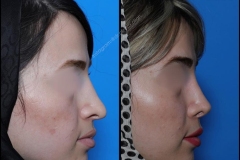 nose-surgery-0144