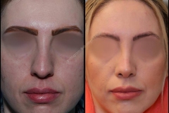 nose-surgery-0145