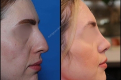 nose-surgery-0146