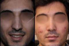nose-surgery-0147