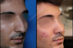 nose-surgery-0148