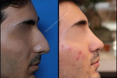 nose-surgery-0149