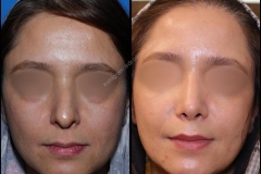 nose-surgery-0150