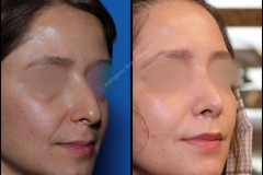 nose-surgery-0151