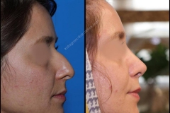 nose-surgery-0152