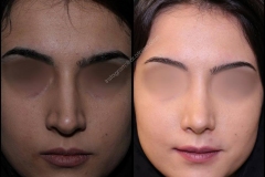 nose-surgery-0153