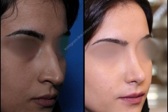 nose-surgery-0154
