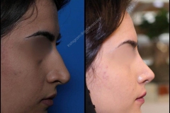 nose-surgery-0155