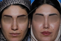 nose-surgery-0156