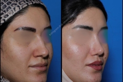 nose-surgery-0157