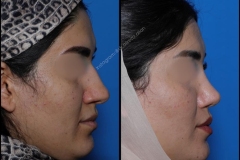 nose-surgery-0158