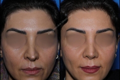 nose-surgery-0159