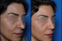 nose-surgery-0160
