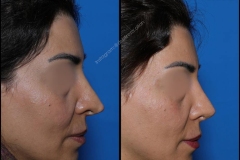 nose-surgery-0161