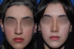 nose-surgery-0162