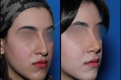 nose-surgery-0163