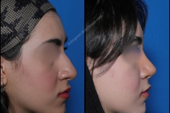 nose-surgery-0164