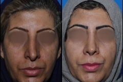 nose-surgery-0165
