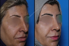 nose-surgery-0166