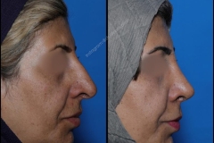 nose-surgery-0167