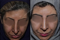nose-surgery-0168
