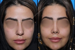nose-surgery-0169