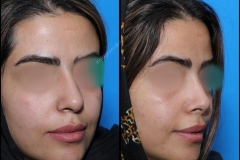 nose-surgery-0170