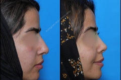 nose-surgery-0171