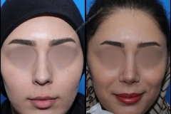 nose-surgery-0172