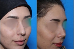 nose-surgery-0173