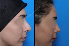 nose-surgery-0174