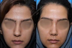 nose-surgery-0175