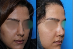 nose-surgery-0176