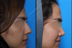 nose-surgery-0177
