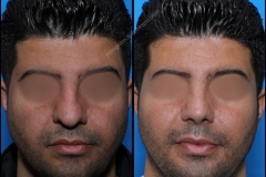 nose-surgery-0178