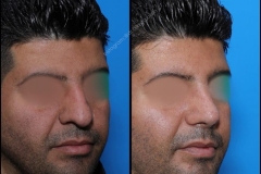 nose-surgery-0179