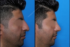 nose-surgery-0180
