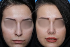 nose-surgery-0181