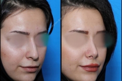nose-surgery-0182