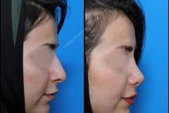 nose-surgery-0183
